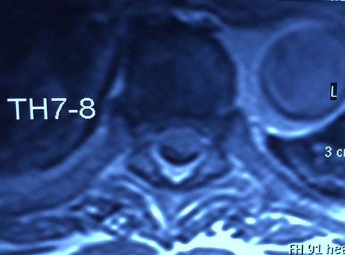 MRI image of an 82-year old patient with an intradural-extramedullary tumor (meningioma Grade I according to WHO) 