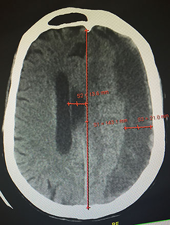 Εικόνα αξονικής τομογραφίας ασθενούς με χρόνιο υποσκληρίδιο αιμάτωμα αριστερά και μεγάλη παρεκτόπιση των στοιχείων της μέσης γραμμής προς τα δεξιά. [ Εικόνα από το προσωπικό μου αρχείο ]