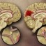 Απεικόνιση αγγειακών εγκεφαλικών επεισοδίων